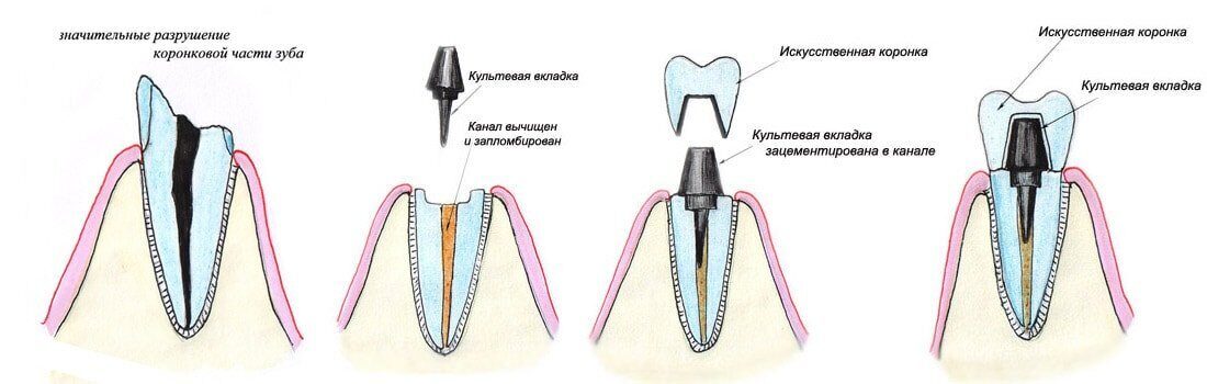 Как осуществляется установка коронки на зуб?